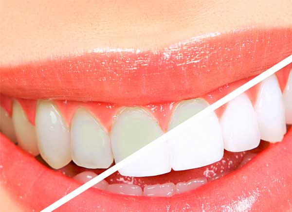 Blanqueamiento – Sonría, clínicas dentales