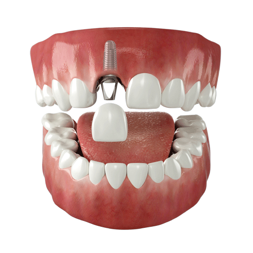 Implantes dentales – Sonría